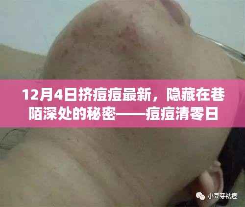 巷陌深处的秘密,痘痘清零日体验记