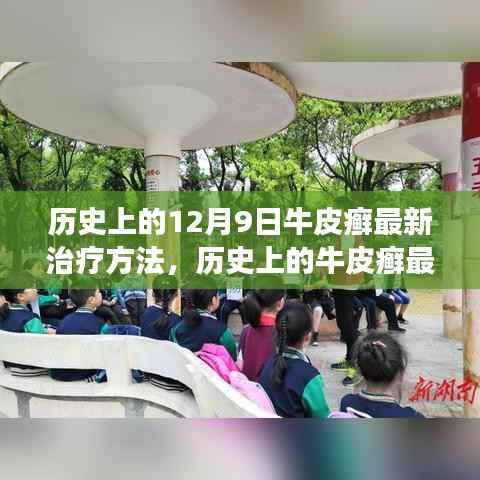 十二月九日牛皮癣治疗历程，从探索到突破的时间线脉络下的最新疗法