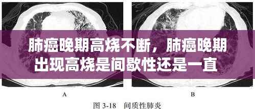 肺癌晚期高烧不断，肺癌晚期出现高烧是间歇性还是一直 