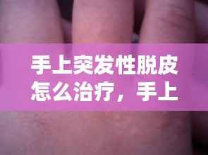 手上突发性脱皮怎么治疗，手上突然脱皮怎么办 