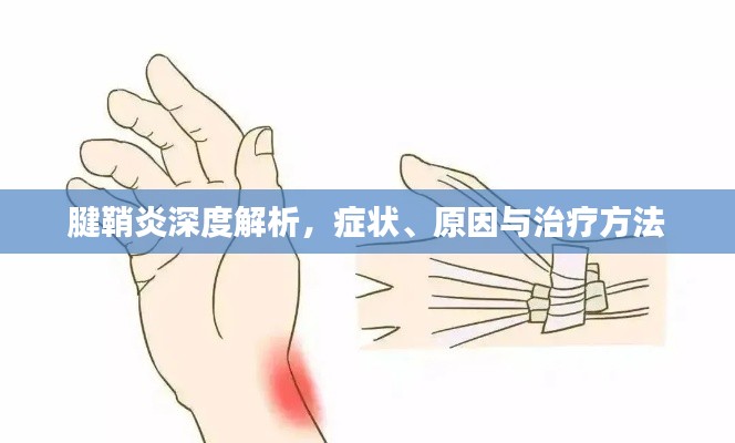 腱鞘炎深度解析，症状、原因与治疗方法
