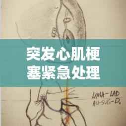 突发心肌梗塞紧急处理指南，救命知识，不容错过！